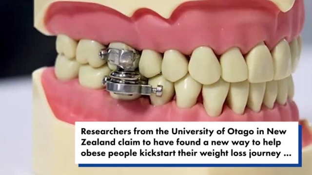 لاغری با دستگاهی که به دندان ها قفل می شود 
