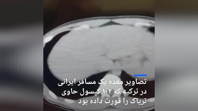 کشف 102 کپسول‌ حاوی تریاک در معده یک ایرانی در ترکیه | فیلم 