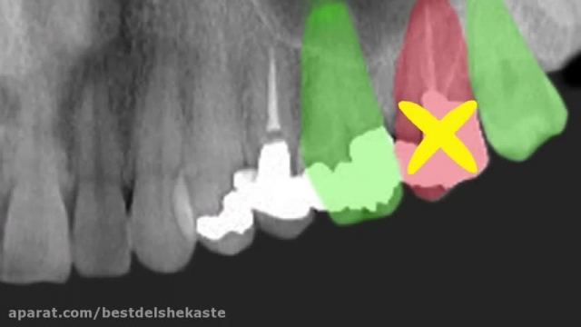 دانلود ویدیو ای از  ایمپلنت دندان