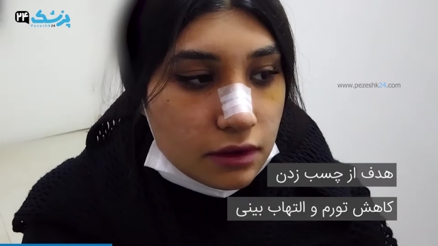 فیلم چسب زدن بینی  | چسب زدن بینی بعد از عمل 