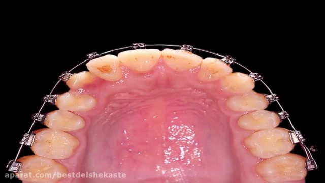 دانلود ویدیو ای درباره ی ارتودنسی بدون کشیدن دندان با سیستم دیمون